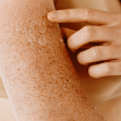 Kūno švetimas - sausos odos išsigelbėjimas